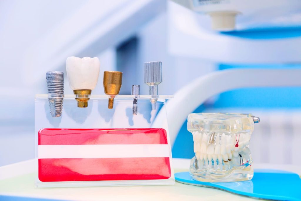 Quanto dura un impianto dentale? Tutto quello che c’è da sapere 1 quanto dura un impianto dentale
